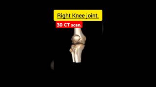 CT scan Knee anatomy ctscan kneejoint kneejointpain anatomy freshers medicalimaging medico [upl. by Garrick167]