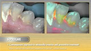 SoproCARE Dentrek Module [upl. by Irvine690]