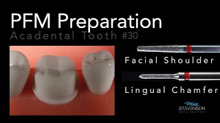 PFM Preparation  Acadental Tooth 30  Dr Richard Stevenson [upl. by Repsag936]