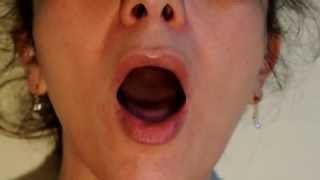 Video 10  Bulbar Palsy  Tongue fasciculations  Atteinte bulbaire  Fasciculations de la langue [upl. by Marc]