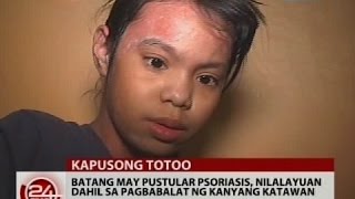 24Oras Sakit ni Zachary na Pustular Psoriasis hindi nakakahawa ayon sa dermatologist [upl. by Jola]