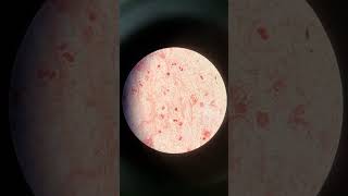 Gram Staining of Sputum Abundant Pus Cells with Absence of Microbial Involvement [upl. by Jobe620]