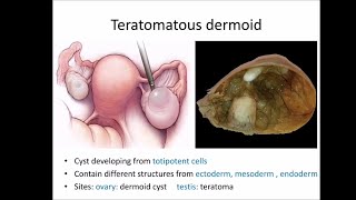 Dermoid cyst [upl. by Traver]