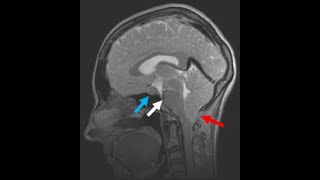 Cerebrospinal Fluid Leak Symptoms Causes Treatment [upl. by Rodgers913]