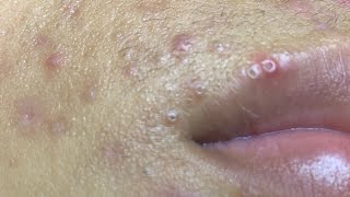 Blackheads ​⁠BYoungSpa [upl. by Tahpos771]