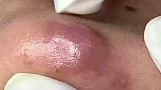 Blackheads Removal  Acne Treatment and Very Satisfying Satisfying Pimple pop blackheads [upl. by Perry806]