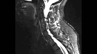 Interspinous Ligamentous Injury [upl. by Ellebyam137]