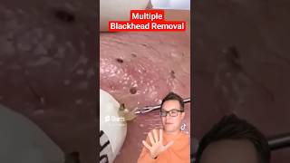 Record Breaking BLACKHEAD REMOVAL  Most Blackhead Pops shorts [upl. by Suravart]