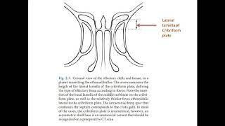 lateral lamella of cribriform plate [upl. by Finn]