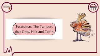 Teratomas Tumours With Eyes Hair and Teeth [upl. by Reivazx430]