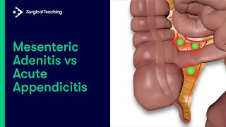 Mesenteric Adenitis vs Appendicitis  How to tell the difference [upl. by Viquelia]