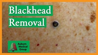 Blackhead Removal without Extractor Tool Edited  Auburn Medical Group [upl. by Eanel]