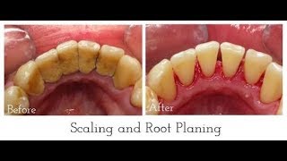 Periodontal Disease Treatment [upl. by Retse]