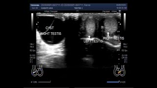 Ultrasound Video showing Epididymal Cyst in a child of about five months [upl. by Namdor]