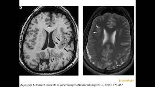 9 Polymicrogyria PMG cortical malformation post migratory glial limiting membrane neuroimaging [upl. by Glenna983]