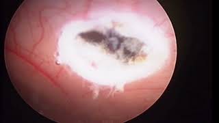 Endoscopic Septostomy [upl. by Hardej105]