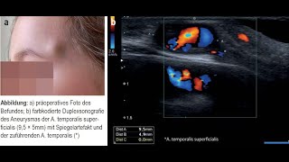 Traumatisches Aneurysma der A temporalis superficialis bei einem 4 jährigen Kind [upl. by Ibur]