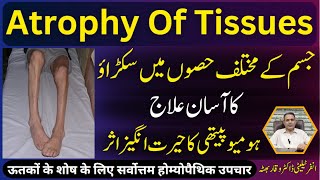 Atrophy Of Tissues جسم مین سکڑاؤ शारीरिक संकुचन Homeopathic Treatment In Urdu  Hindi [upl. by Fornof]