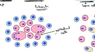 GENERAL PATHOLOGY 36  Tissue reactions in different types of granulomas DR SAMEH GHAZY [upl. by Enymsaj]