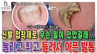 💦무좀 발톱💦 접착제 때문에 발톱이 이상해질 수 있나요 순간 방심한 사이에 심해진 유해균 발톱 😣 발톱닥터 무좀발톱 무좀발톱스케일링 무좀발톱관리 지축역 [upl. by Urban332]