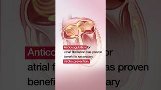 Apixaban to Prevent Recurrence After Cryptogenic Stroke in Patients With Atrial Cardiopathy [upl. by Ettevi]