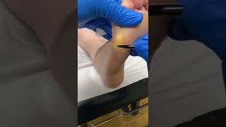 Expert Australian Podiatrist Removes Thick Callus from Forefoot with Precision [upl. by Notelrahc]