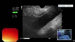 EUS examination of mediastinum Subcarinal space [upl. by Airekat]