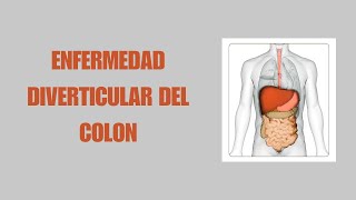 ENFERMEDAD DIVERTICULAR DEL COLON  2024  II [upl. by Neilla]