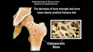 understanding Osteoporosis  Everything You Need To Know  Dr Nabil Ebraheim [upl. by Herta150]