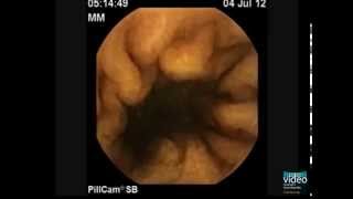 The PillCam Detection of Meckels Diverticulum [upl. by Dyrrej]