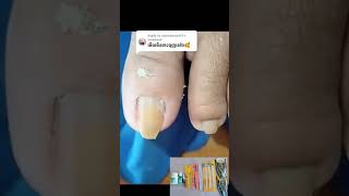 Thick toenail treatment nail​​​ asmr fyp ear shorts viral wax [upl. by Stutsman]