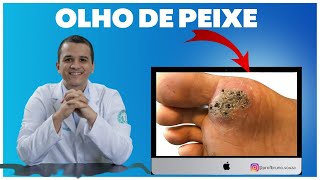 O que é verruga de verdade  HPV papilomavirus famoso quotolho de peixequot você já teve em mãos ou pés [upl. by Necyla]