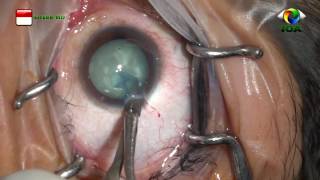 Cataract Surgery FAST PHACO 1288 [upl. by Zacharias]