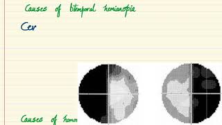 Ocular signs  Bitemporal Hemianopia and Homonymous Hemianopia [upl. by O'Hara]