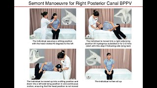 Semont Manoeuvre for Right Posterior Canal BPPV [upl. by Aitnyc]