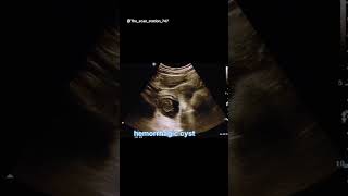 Hemorrhagic cystabdomen usg pediatrician doctor babydoctor ultrasound ultrasoundreport [upl. by Iroak]