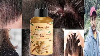 Deyga Anti Dandruff Oil  Honest Review [upl. by Mattland]