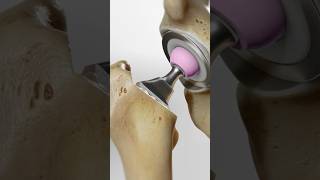 Total hip replacement explained 3D Animation [upl. by Yllac]