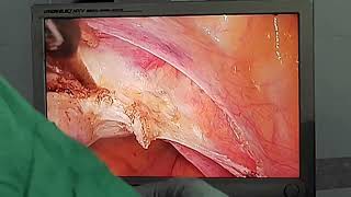 Laparoscopic hysterectomy by drTR Joy amp dr Jakir [upl. by Shelbi]