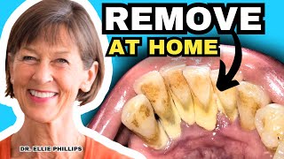 Tartar Removal At Home and How To Prevent Tartar [upl. by Nalra]