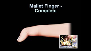 Mallet Finger Complete  Everything You Need To Know  Dr Nabil Ebraheim [upl. by Sancho]