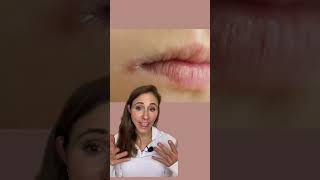 How To Get Rid Of Angular Cheilitis For Good dermatologist [upl. by Nnahgiel]