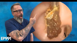 HOW TO SAFELY REMOVE A HUGE EAR WAX PLUG Earwax removal  EP991 [upl. by Ribak603]