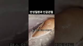 만성질환 환자가 인공관절 수술을 해도 될까요 인공관절수술 퇴행서관절염 천연글루칸 관절염연구소 [upl. by Jasen]