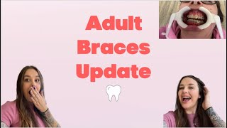 BRACES UPDATE PART 12 MY BRACES ARE COMING OFF Exciting news [upl. by Gney]