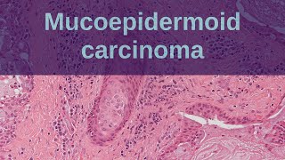 Mucoepidermoid Carcinoma of Salivary Glands  Pathology mini tutorial [upl. by Selby]