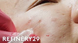 I Got Fillers For My Acne Scars  Macro Beauty  Refinery29 [upl. by Atteuqal600]