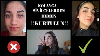 SİVİLCELERDEN HEMEN KURTUL HAP KULLANMADAN NASIL YOK ETTİM [upl. by Altheta]