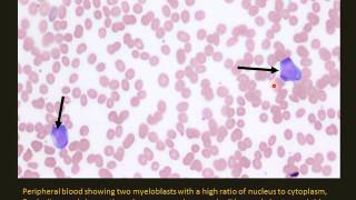 Pediatric Leukemia and lymphoma [upl. by Branham]