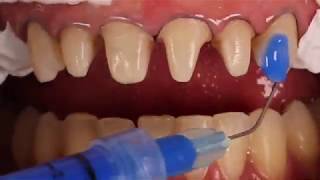 Adhesive cementation of ceramic veneers [upl. by Anilet]